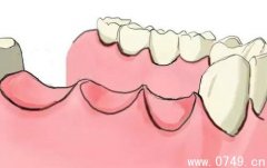 缺牙后应及时镶牙 连累消化系统