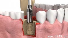 微创种植牙术后注意事项 保存口腔卫生