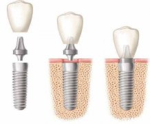 种植牙全过程，专业医师告诉你！