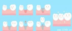 种植牙是如何“种”出来的？什么是种植牙？
