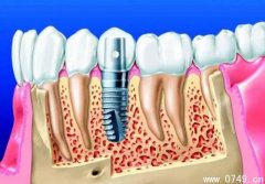 种植牙的寿命和价格 种植牙能使用多久