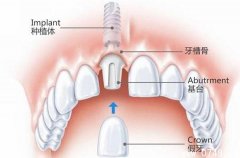种植牙的原理是什么？直接打钢钉不疼吗？